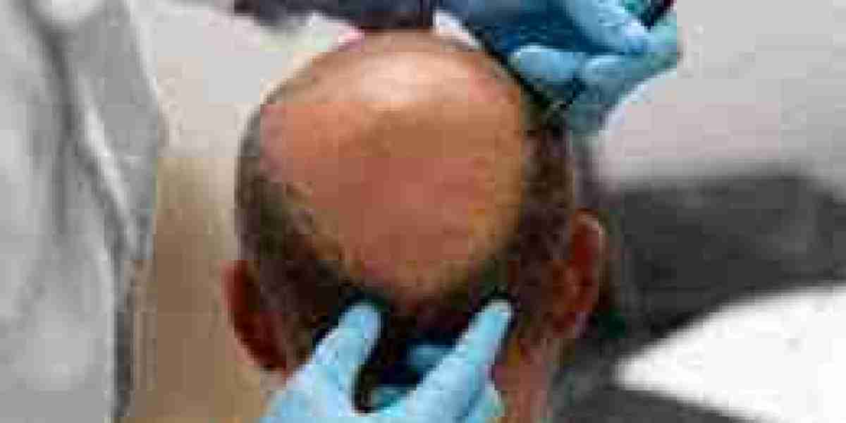 Why Riyadh is the Hub for World-Class Hair Transplant Treatments