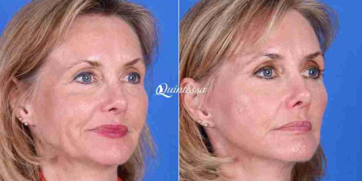 Revitalizing Beauty with Lumier Med Spa Torrance's Expertise in Dermal Fillers