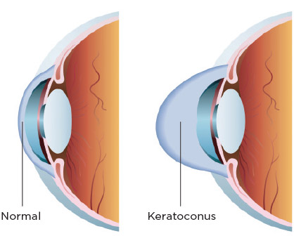 Corneal Cross Linking - Eye LASIK Austin