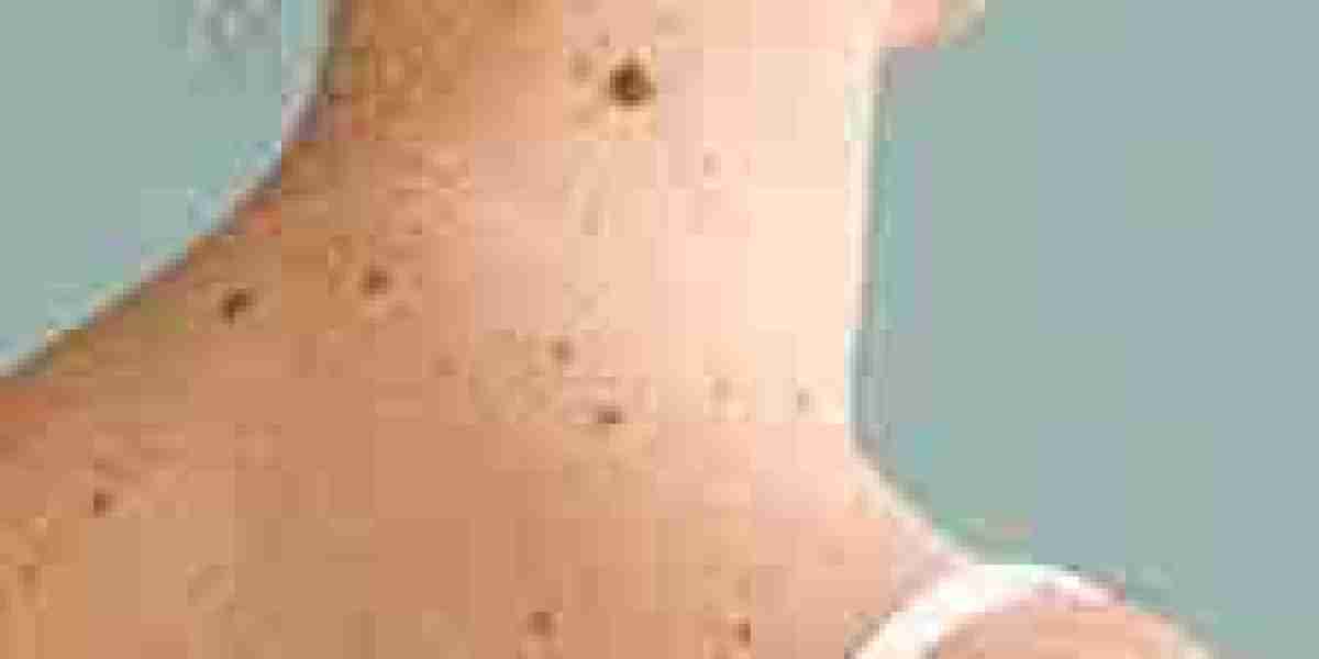 Explore Mole Removal Methods in Islamabad