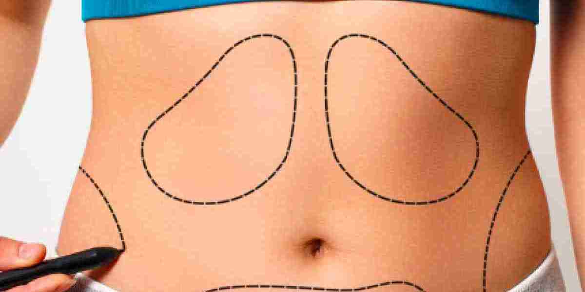 Discover Top Liposuction Clinics in Riyadh: Your Guide to a Sleeker You