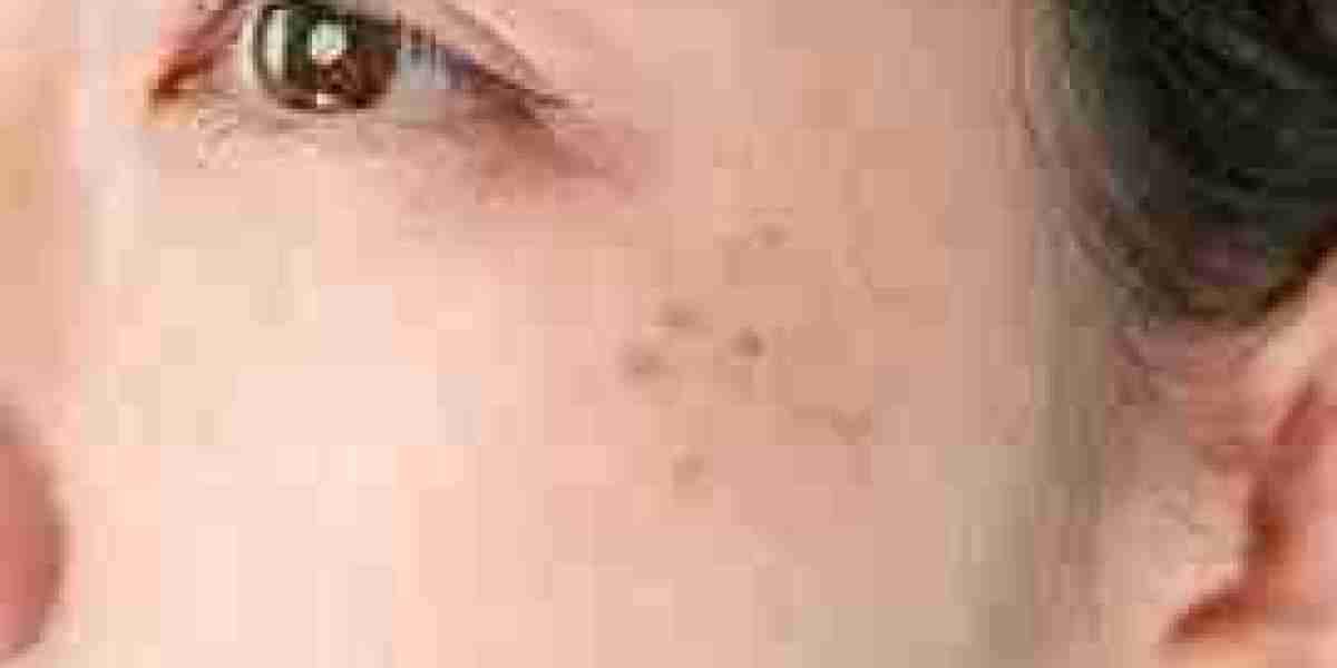 Hyperpigmentation Market Share, Analysis, Epidemiology, Trends and Forecast 2034