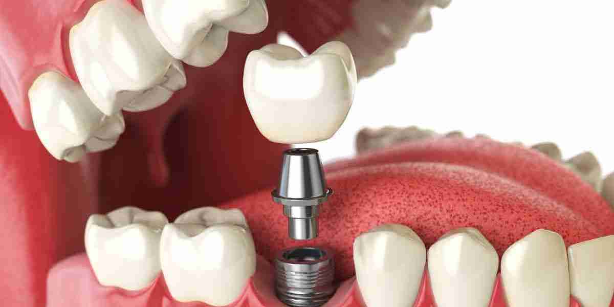 Crecimiento del Mercado de Implantes Dentales: Perspectivas y Proyecciones hasta 2032