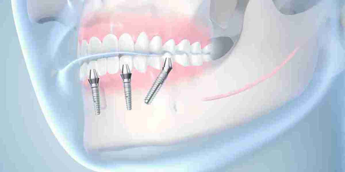 The Ultimate Guide to Dental Implants in Islamabad