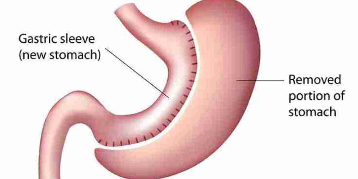 How to Budget for Laparoscopic Sleeve Gastrectomy in Riyadh