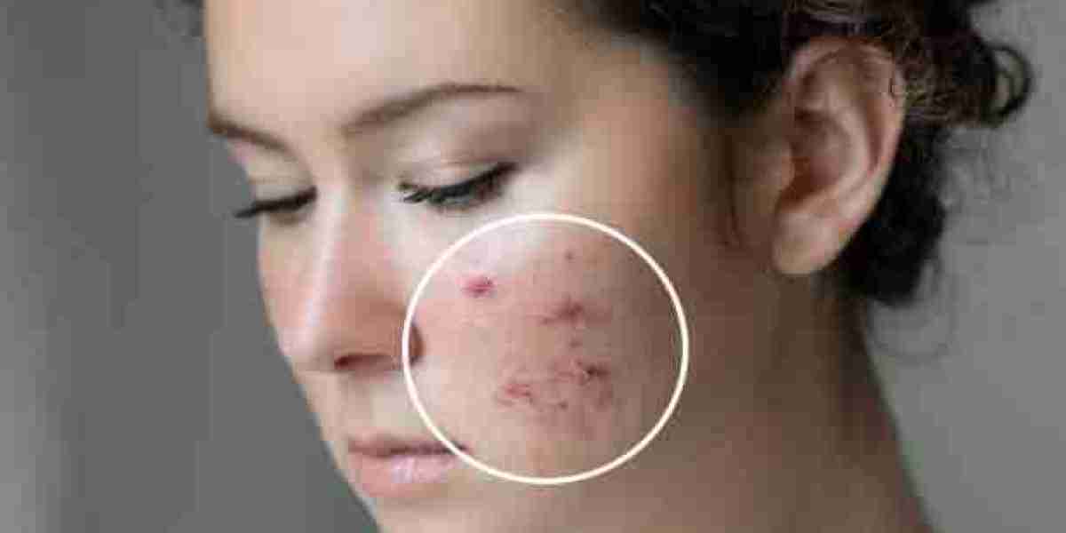 Reclaim Your Skin: Effective Acne Scar Treatments in Islamabad