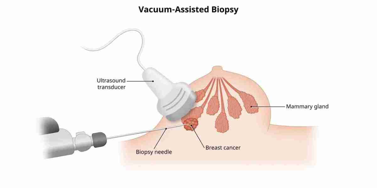 How to Prepare for a Biopsy for Diagnostic Purposes