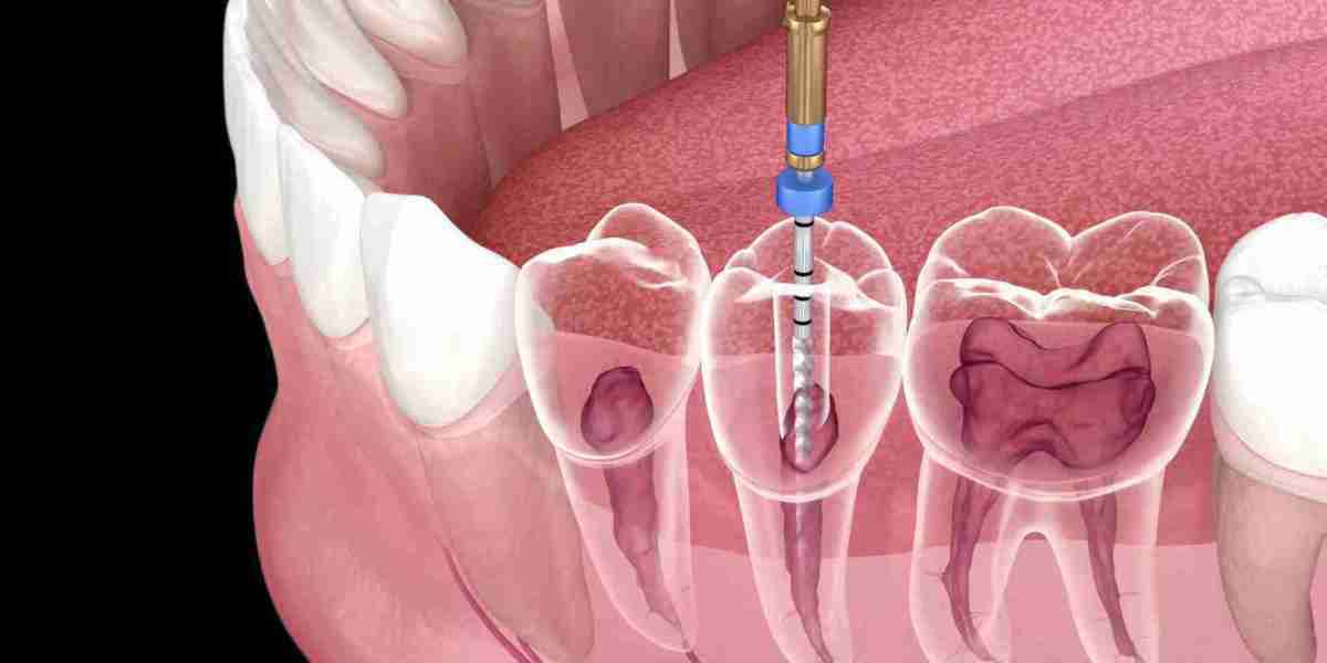 Root Canal and Cosmetic Dentistry in Islamabad: Enhancing Your Smile