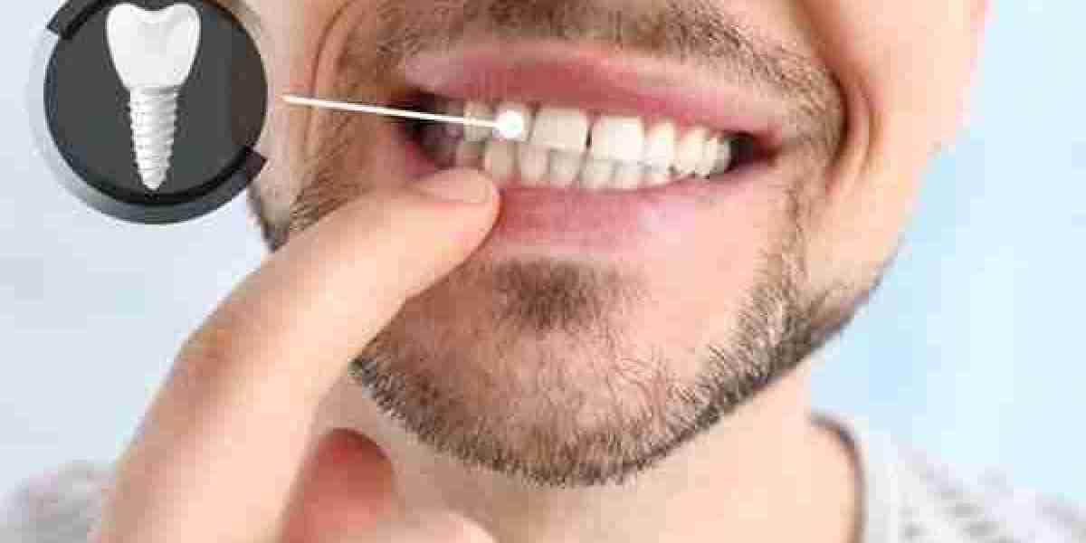 Can You Get Dental Implants with Gum Disease? Insights for Islamabad Patients