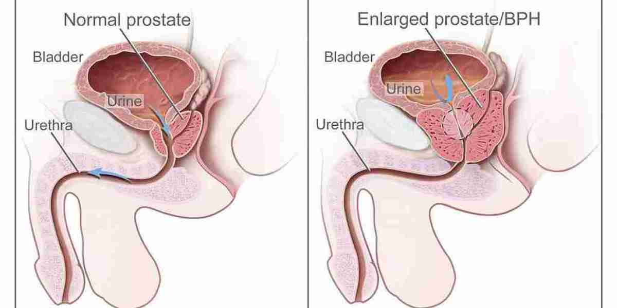 From nmCRPC to mHSPC: Nubeqa’s Expanding Therapeutic Horizons