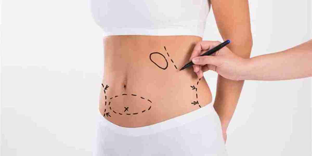 Get the Shape You Desire with Liposuction in Riyadh