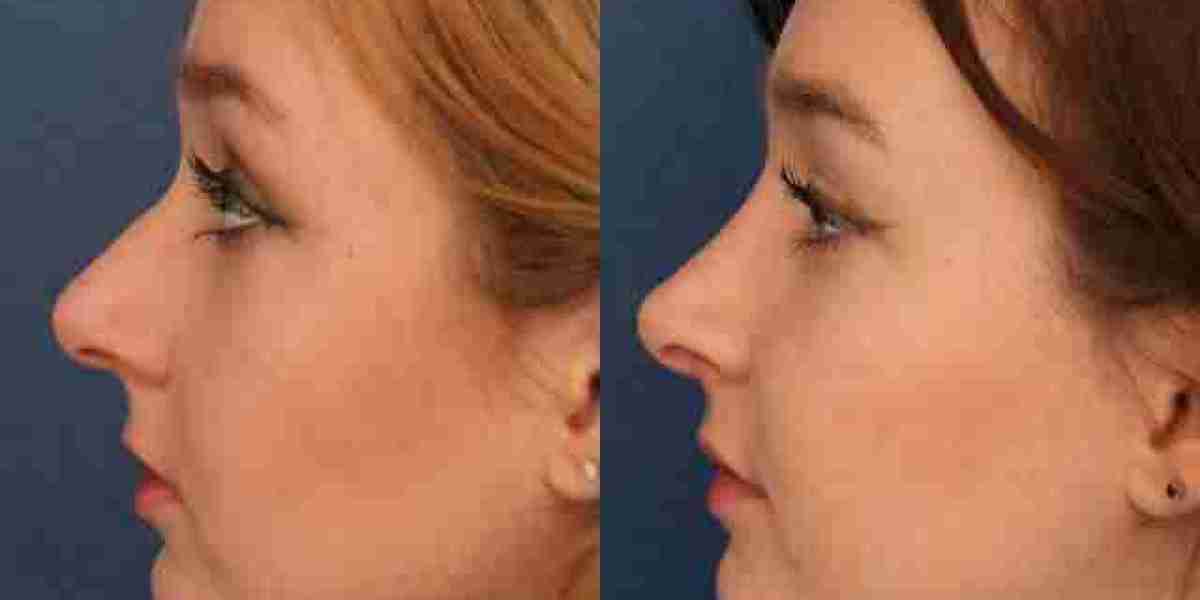 Refine Your Profile with State-of-the-Art Rhinoplasty in Riyadh