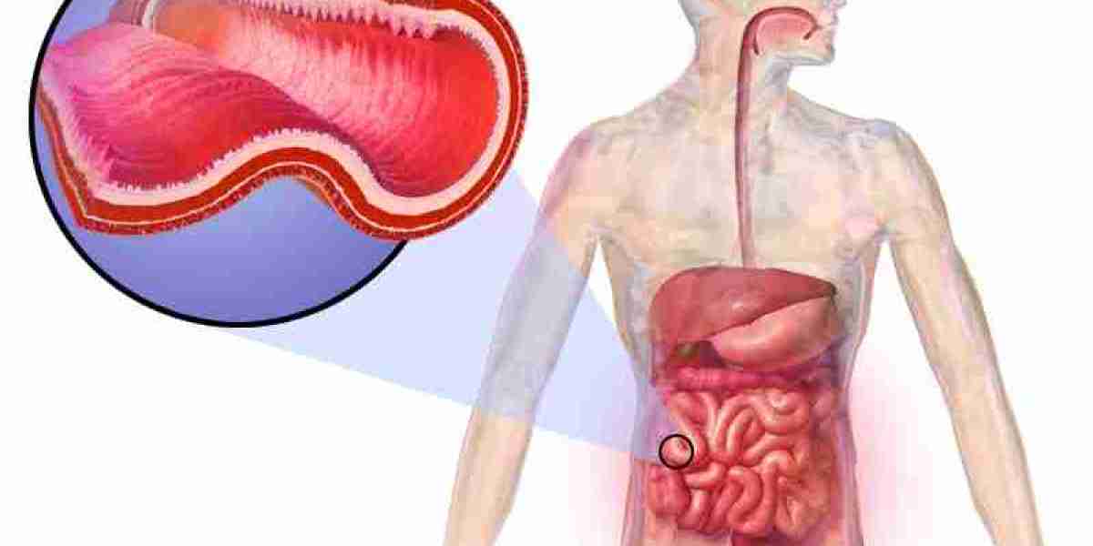 Mechanism Explained: How REMICADE Targets Inflammation in Crohn’s Disease