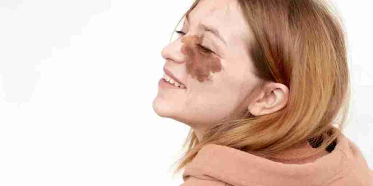 Birthmark Removal in Dubai: How Long Does It Take?