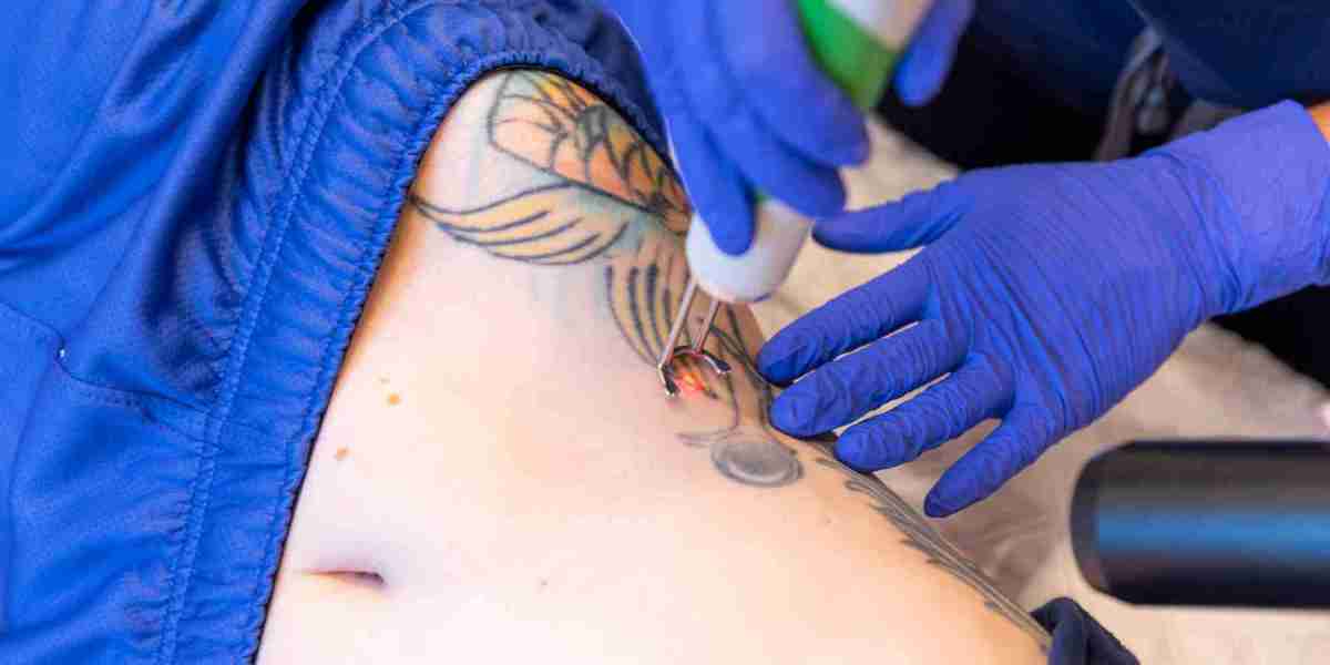 Tattoo Removal in Dubai: Recovery Process