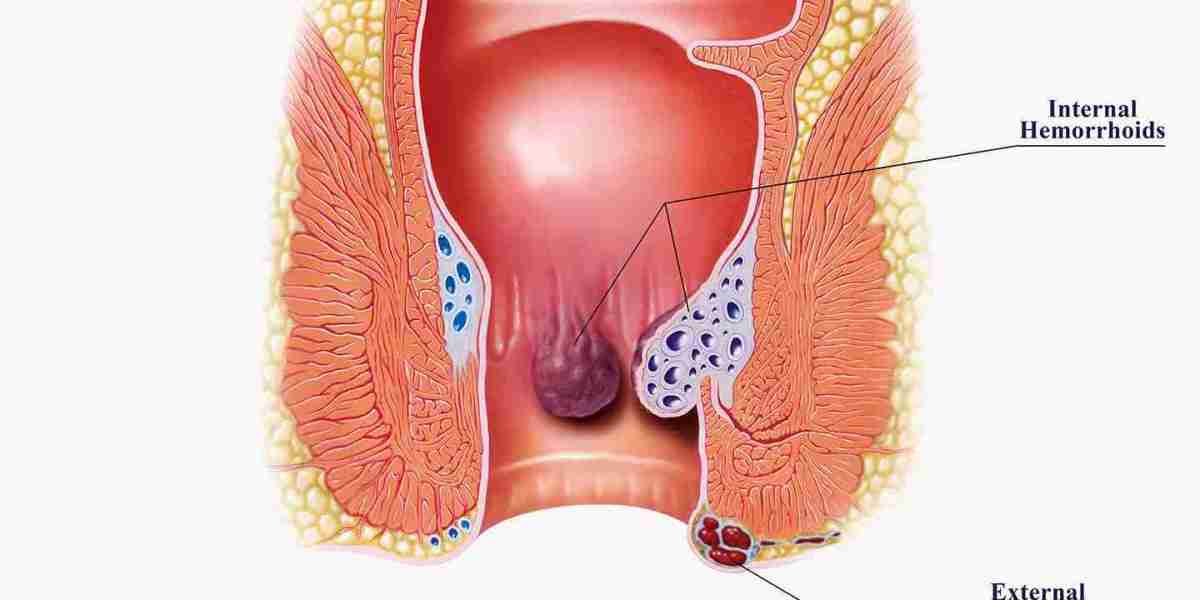 Your Guide to the Best Hemorrhoid Treatment in Riyadh