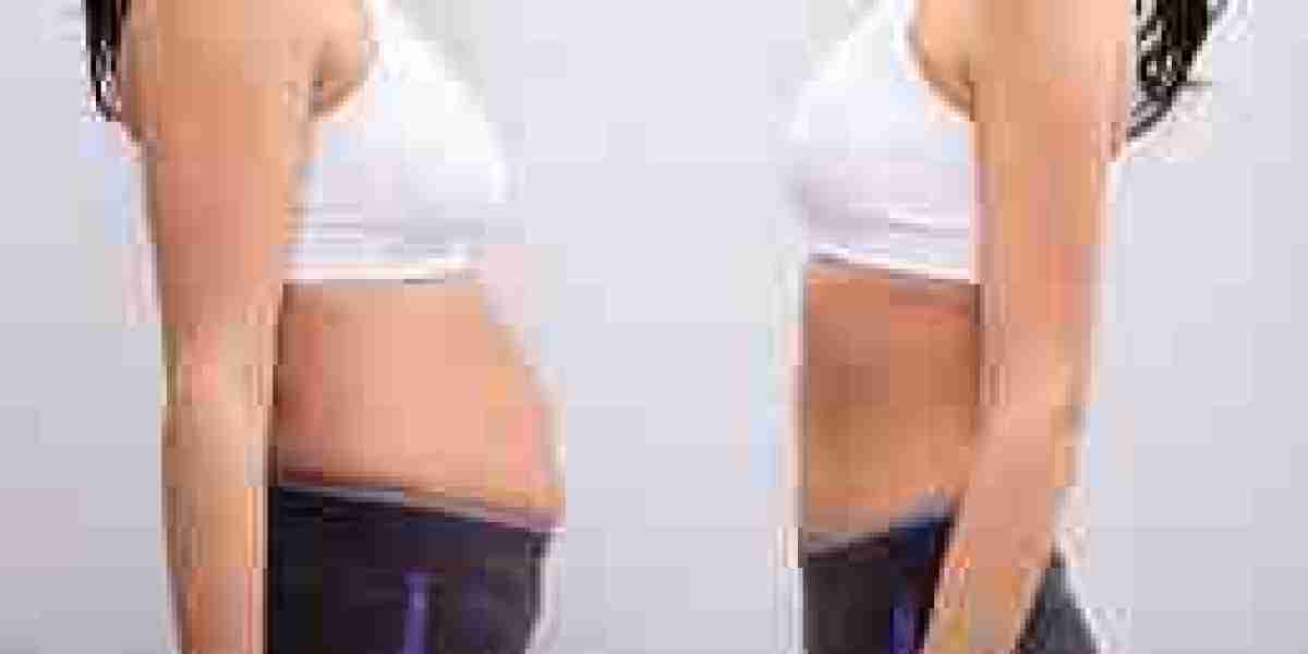 Can You Lose Weight After a Tummy Tuck?