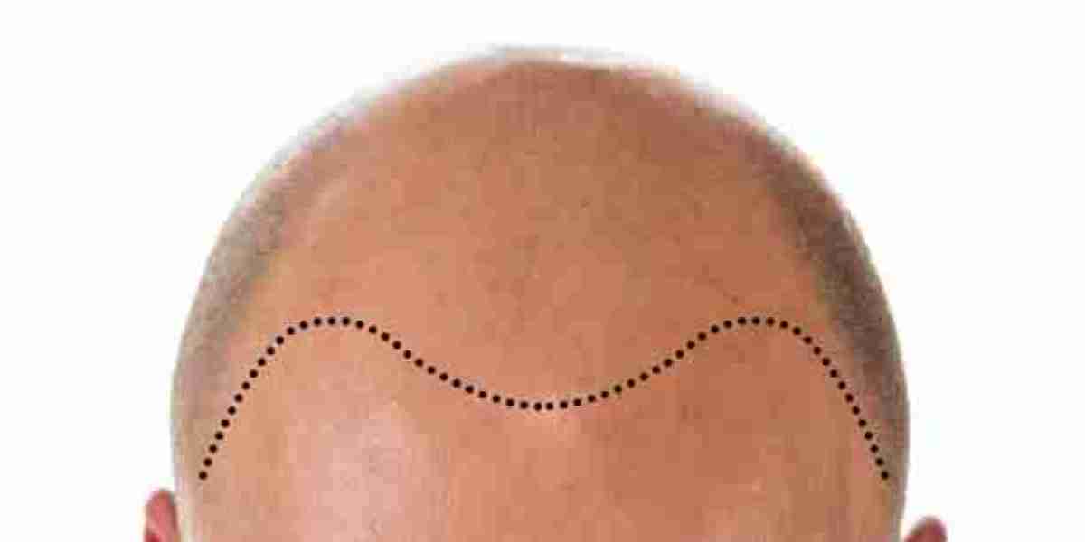 Hair Transplant Cost Factors in Riyadh